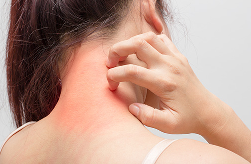 Eczema affected Women