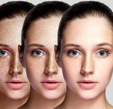 skin pigmentation treatment sharjah