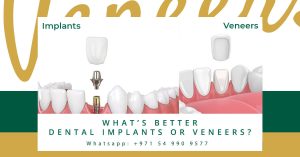 Dental Implants or Veneers