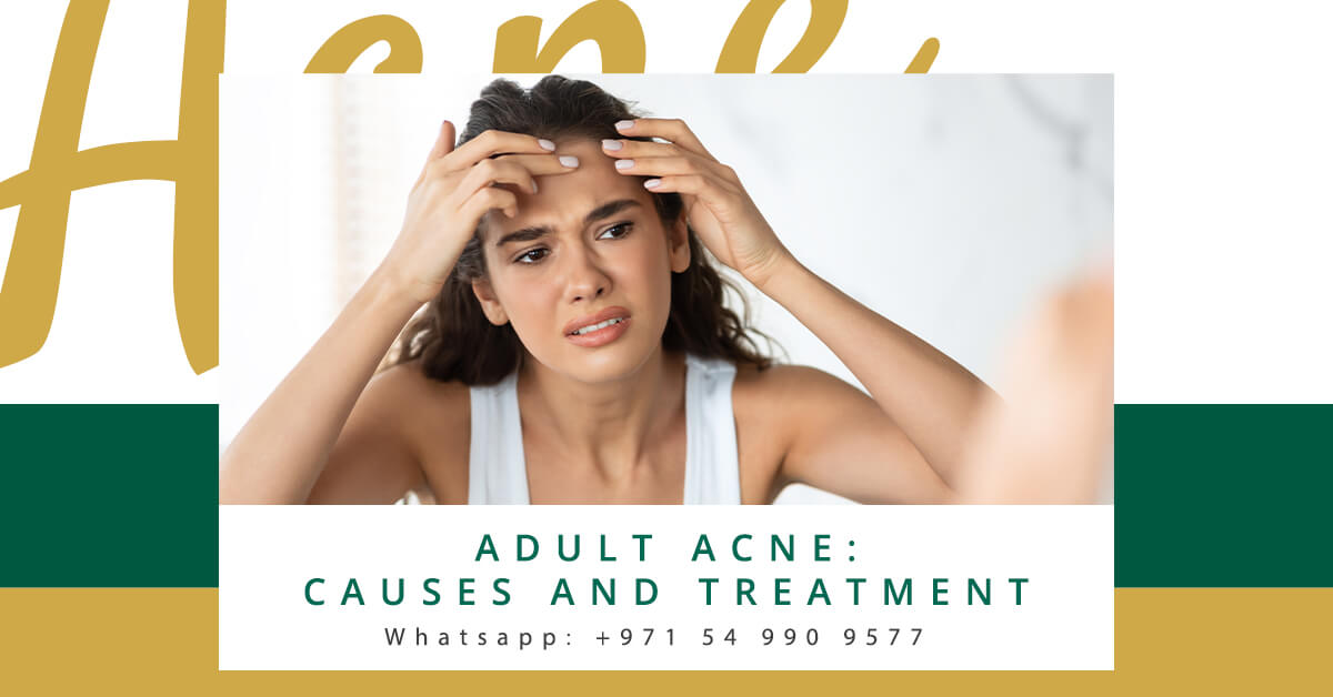 Adult Acne Causes and Treatment