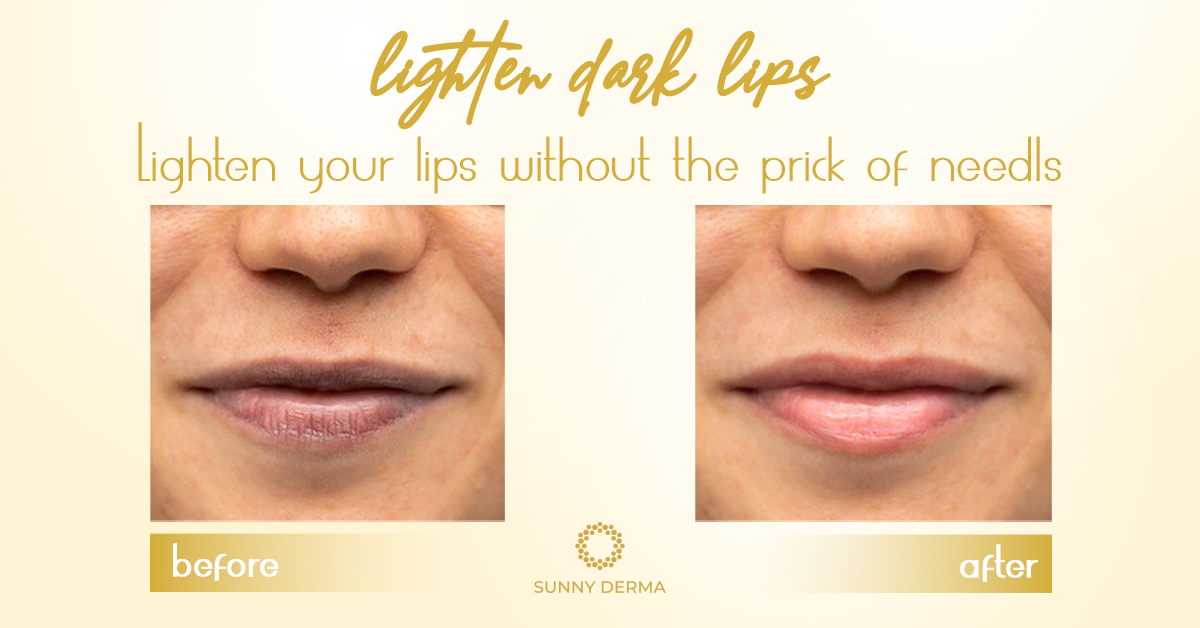  lip lightening whitening treatment
