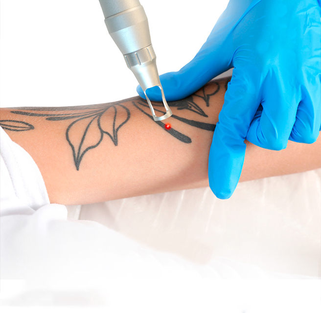 Best Tattoo Removal in Sharjah