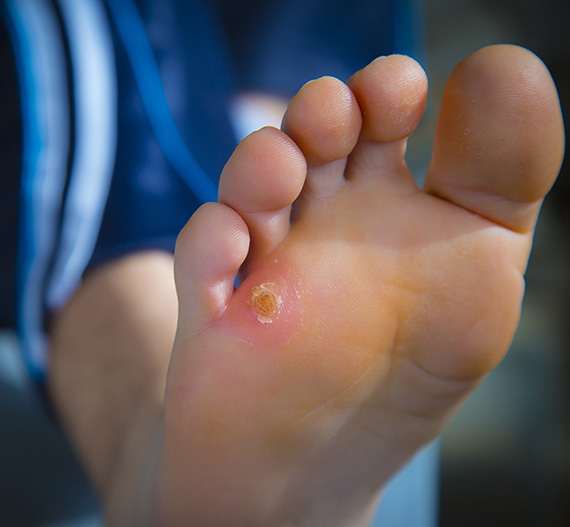 Foot affected with Corn