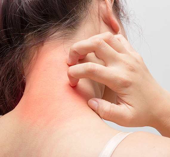 Women having Eczema