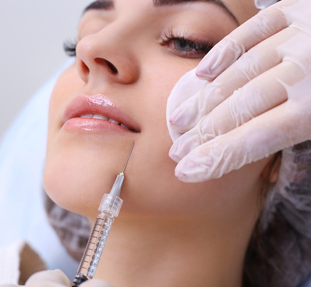 cheek filler for smile lines