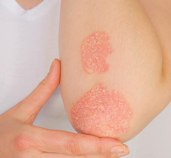 Person with common skin disorder