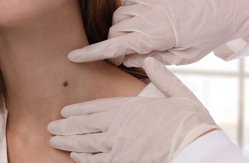 skin tag removal treatment sharjah