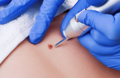 wart removal treatment sharjah