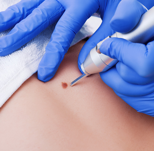 wart removal treatment sharjah