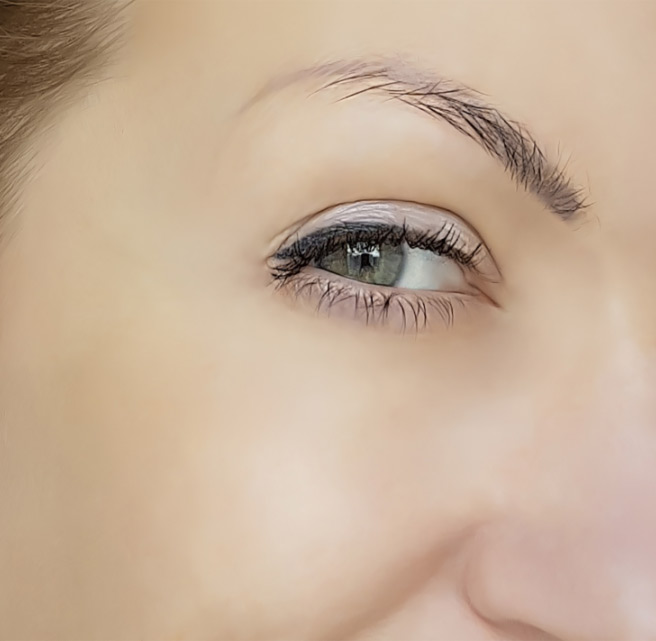 Woman undergone anti-wrinkle treatment