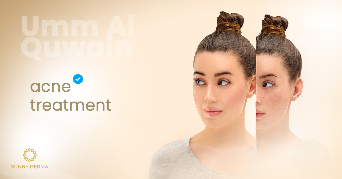 Efffective Acne Treatment in Umm Al Quwain