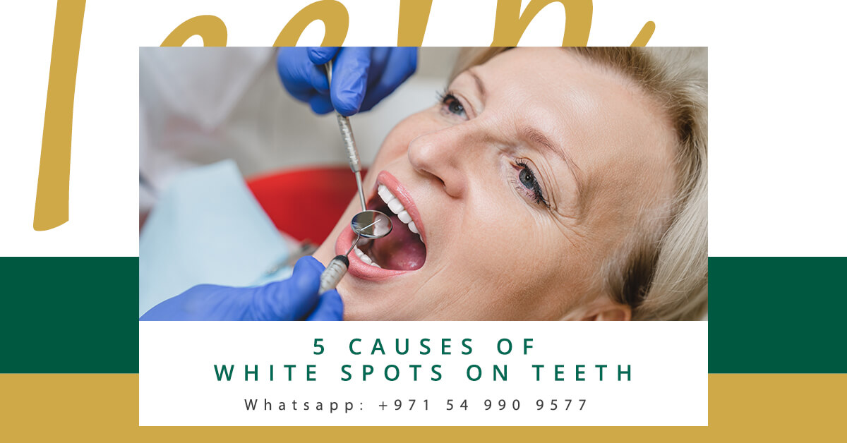Causes of White Spots on Teeth