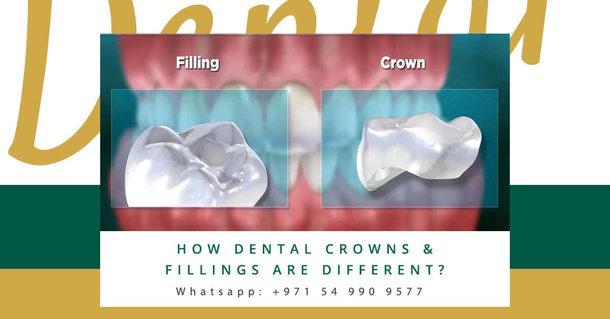 Dental Crowns & Fillings