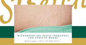 Stretch Marks with Microneedling