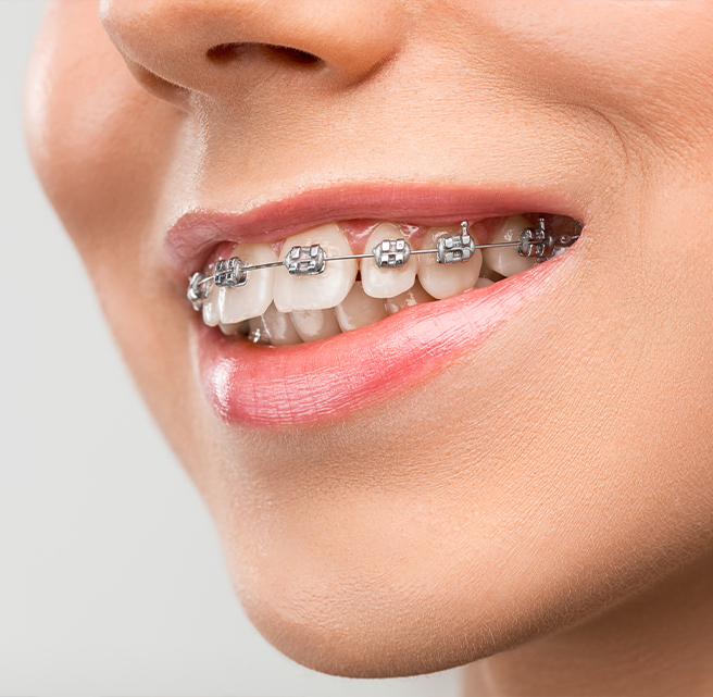 Best Orthodontics - Braces Invisalign Aligners Retainers