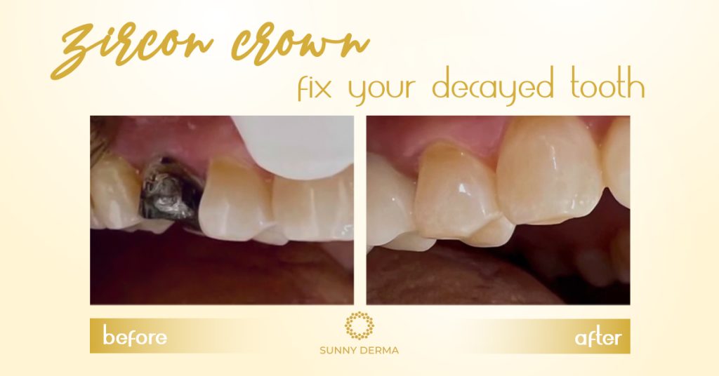 Zirconia Crowns Everything you need to know Dr. Sunny Medical Centre